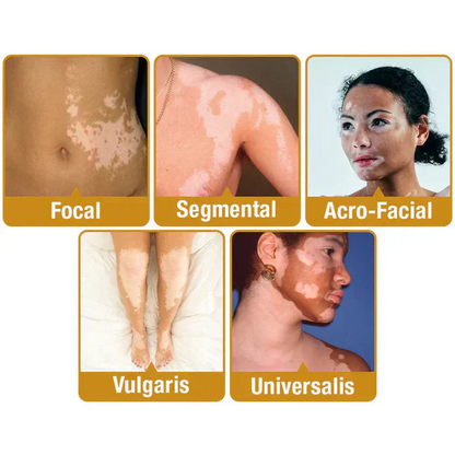 Bee Venom Vitigo Correcting Cream 🧡(BUY1 GET1 FREE )🥳